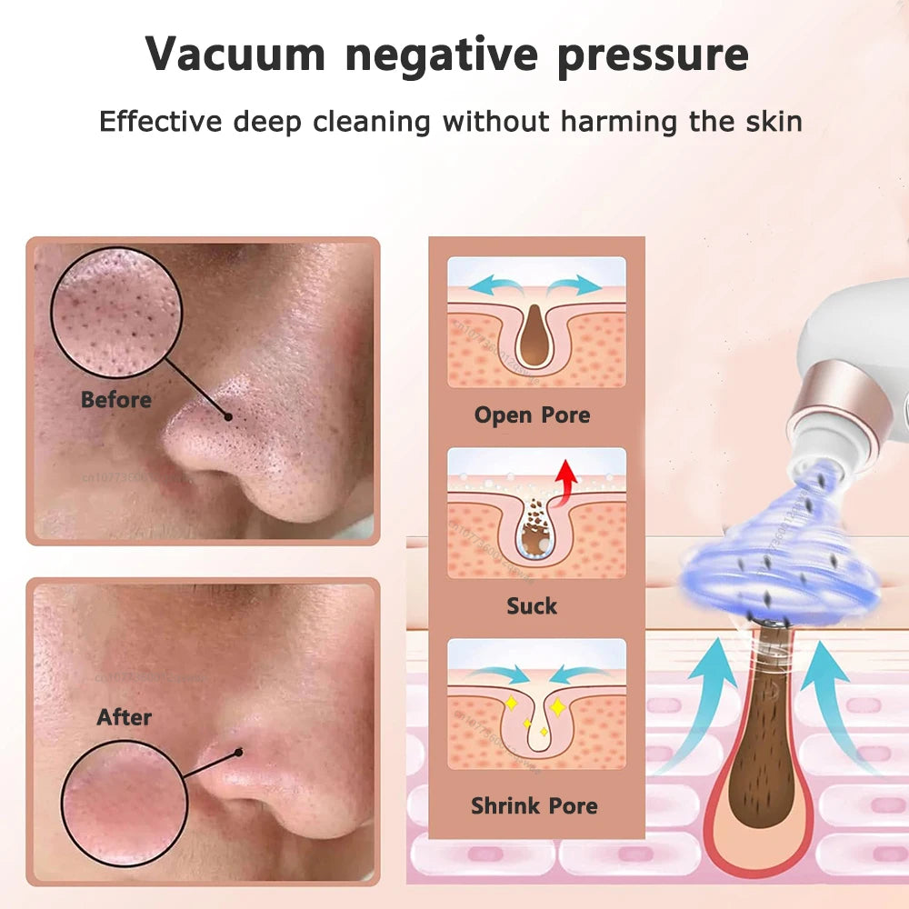 Blackhead Remover Pore Vacuum Face Cleaner Electric Pimple Acne Black Head Removal USB Rechargeable Water Cycle Black Dot Remove